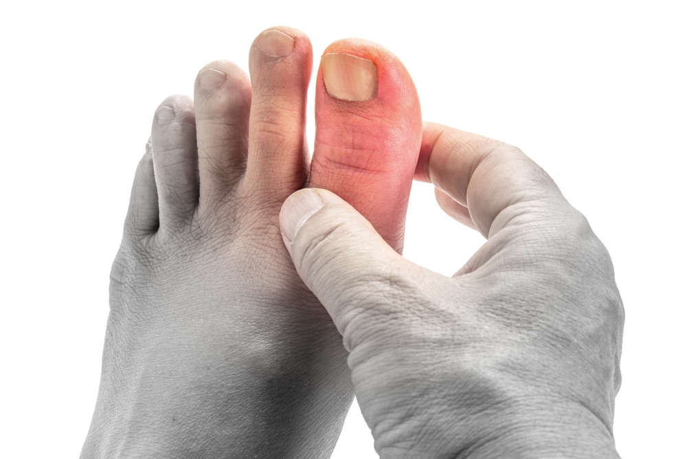 hand holding inflamed big toe affected by gout